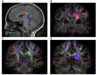 The Superior Fronto-Occipital Fasciculus in the Human Brain Revealed by Diffusion Spectrum Imaging Tractography: An Anatomical Reality or a Methodological Artifact?